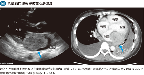 転移性心臓腫瘍｜電子コンテンツ|日本医事新報社