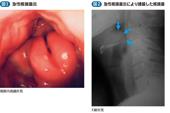 急性喉頭蓋炎 電子コンテンツ 日本医事新報社